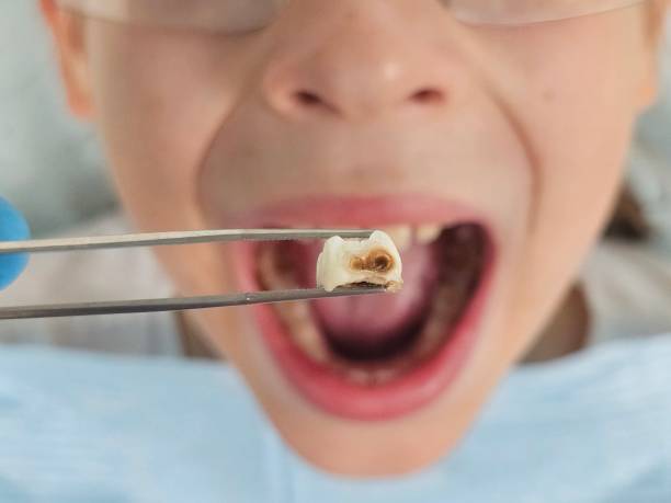 Best Emergency Dental Care for Broken or Chipped Teeth in Hoosick Falls, NY